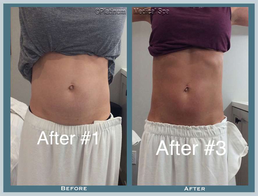 Fat Reduction Before & After