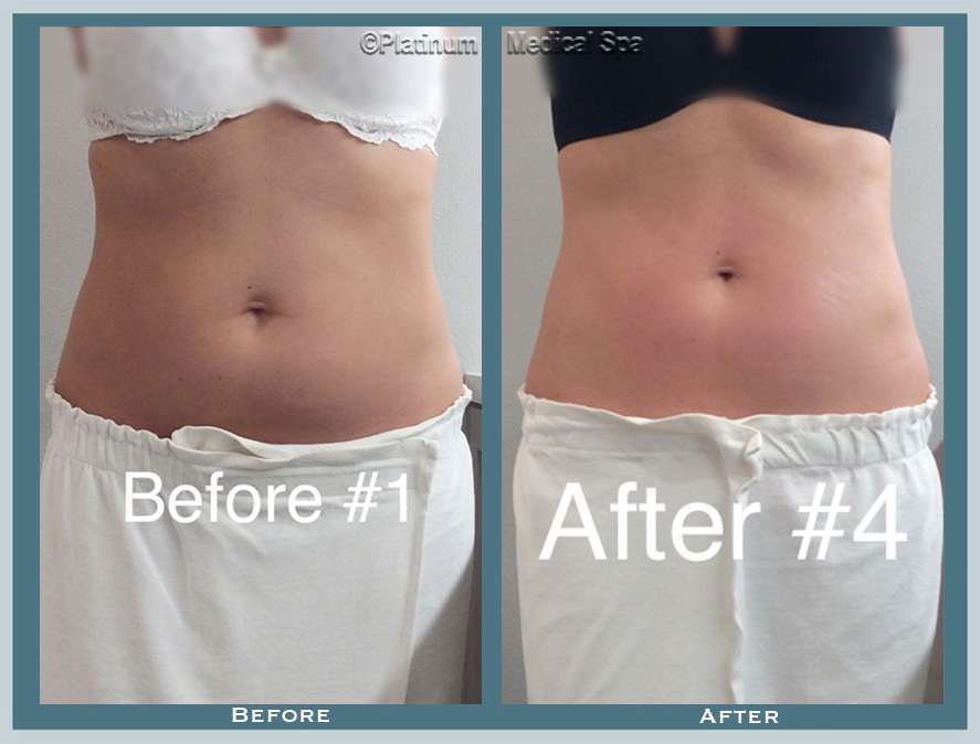 Fat Reduction Before & After