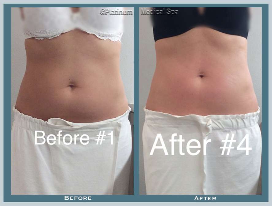 Fat Reduction Orange County