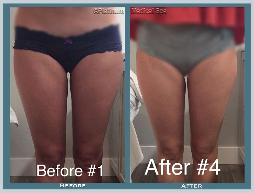 Fat Reduction Before & After