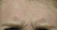 Glabella