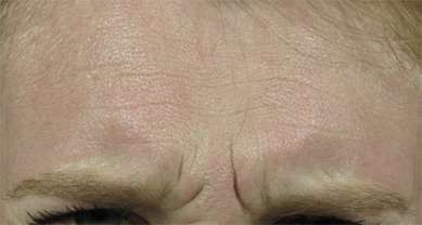 Glabella