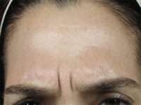 Glabella