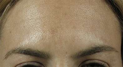 Glabella