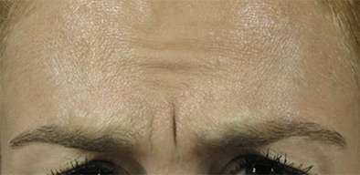 Glabella