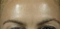 Glabella