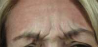 Glabella