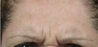 Glabella