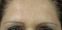 Glabella