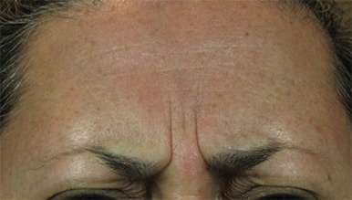 Glabella