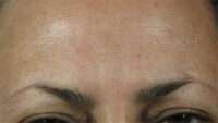 Glabella