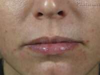 Lip Fillers