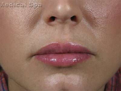 Lip Fillers