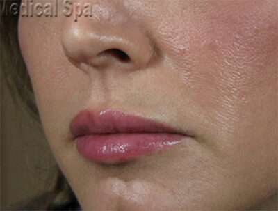 Lip Fillers