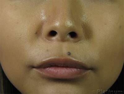 Lip Fillers