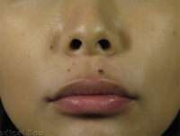 Lip Fillers