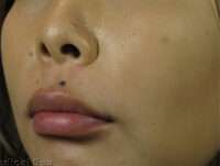 Lip Fillers