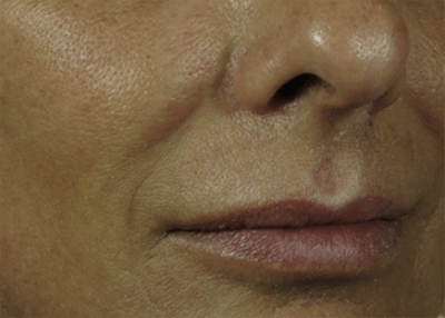 Nasolabial Folds