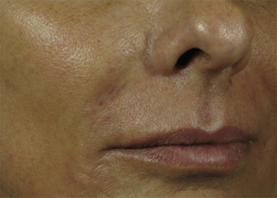 Nasolabial Folds