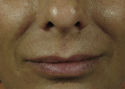 Nasolabial Folds