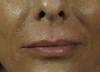 Nasolabial Folds