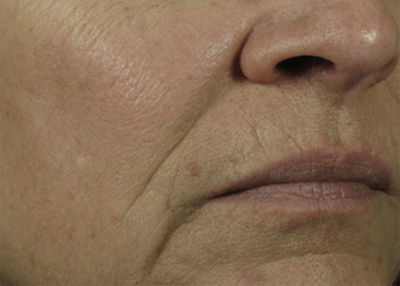 Nasolabial Folds