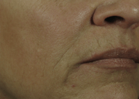 Nasolabial Folds