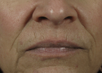 Nasolabial Folds