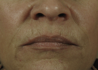 Nasolabial Folds