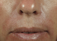 Nasolabial Folds