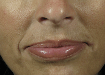 Nasolabial Folds