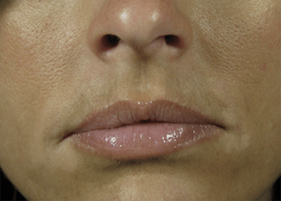 Nasolabial Folds